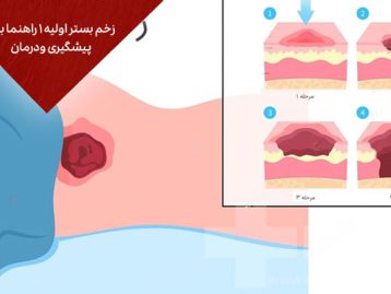 زخم بستر اولیه 1 راهنما برای پیشگیری و درمان